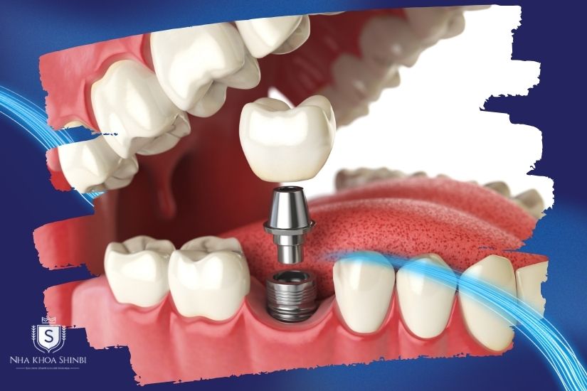Giai đoạn cấy trụ Implant Giai đoạn cấy trụ Implant