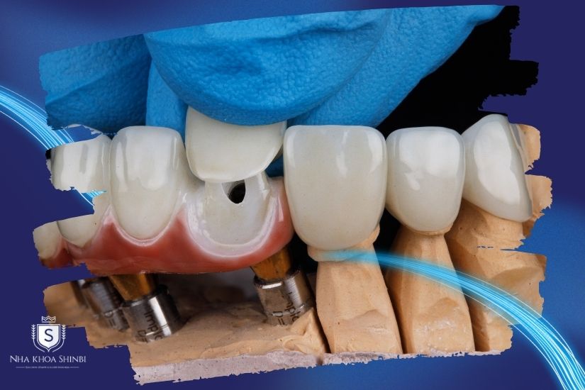 Giai đoạn gắn răng sứ Giai đoạn gắn răng sứ