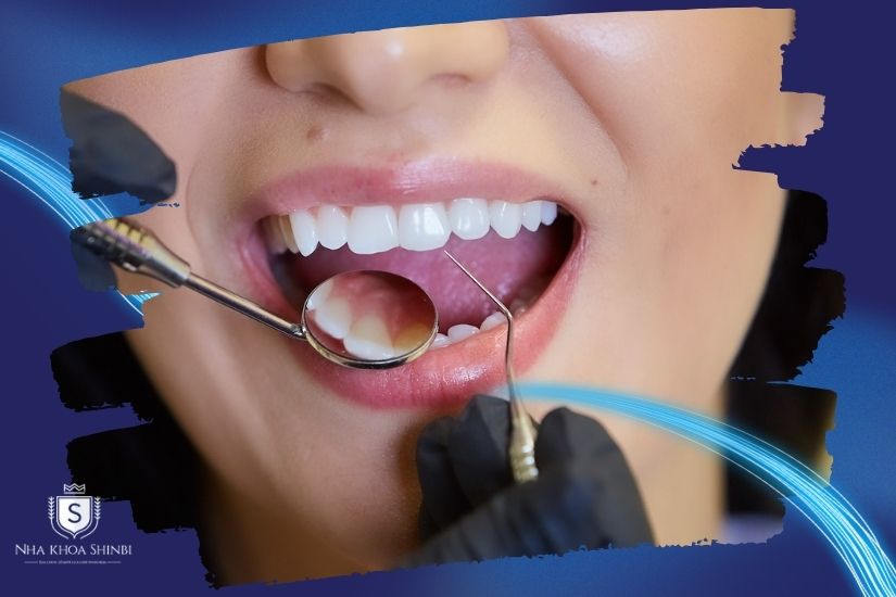 Kiểm tra mật độ và chất lượng xương hàm Kiểm tra mật độ và chất lượng xương hàm