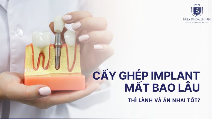 Cấy ghép Implant mất bao lâu thì lành và ăn nhai tốt?