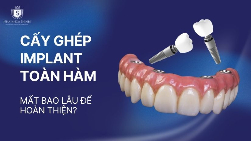 Cấy ghép Implant toàn hàm mất bao lâu để hoàn thiện?