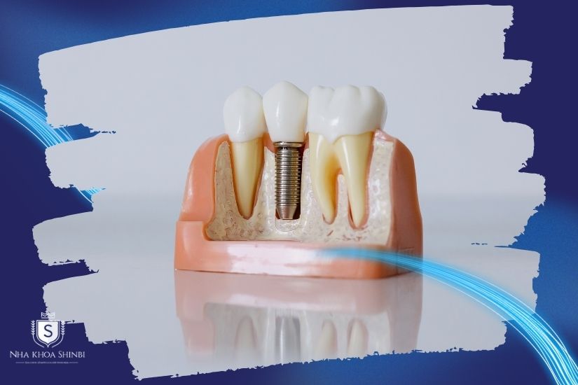 Cấy ghép Implant toàn hàm Cấy ghép Implant toàn hàm