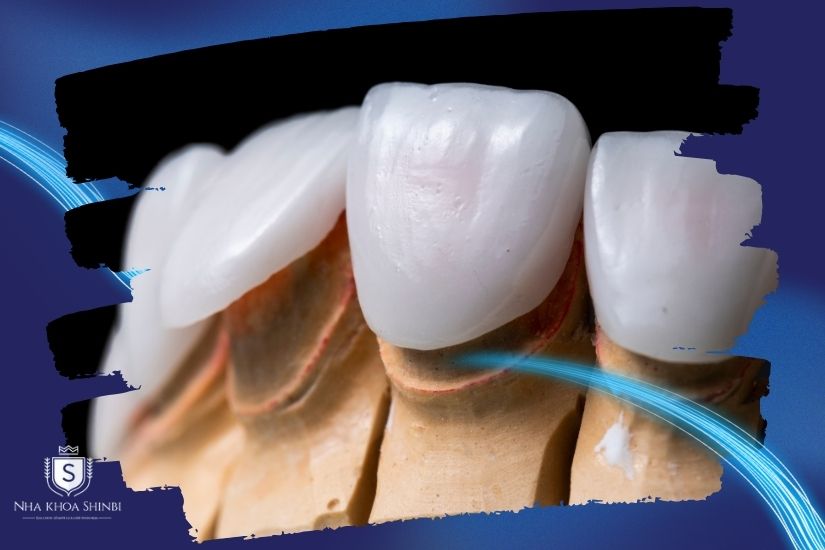 Gắn răng tạm và răng sứ vĩnh viễn Gắn răng tạm và răng sứ vĩnh viễn