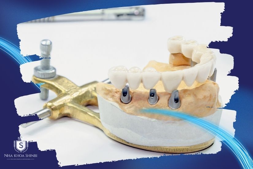Thời gian trung bình để trồng răng implant toàn hàm Thời gian trung bình để cấy ghép implant toàn hàm