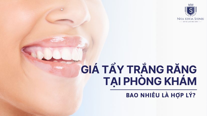 Giá tẩy trắng răng tại phòng khám bao nhiêu là hợp lý?