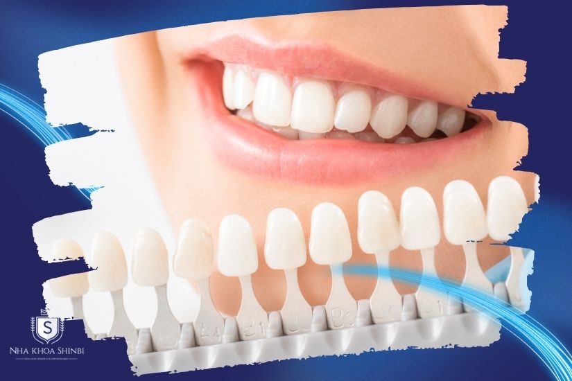 Bao lâu thì làm lại tẩy trắng răng