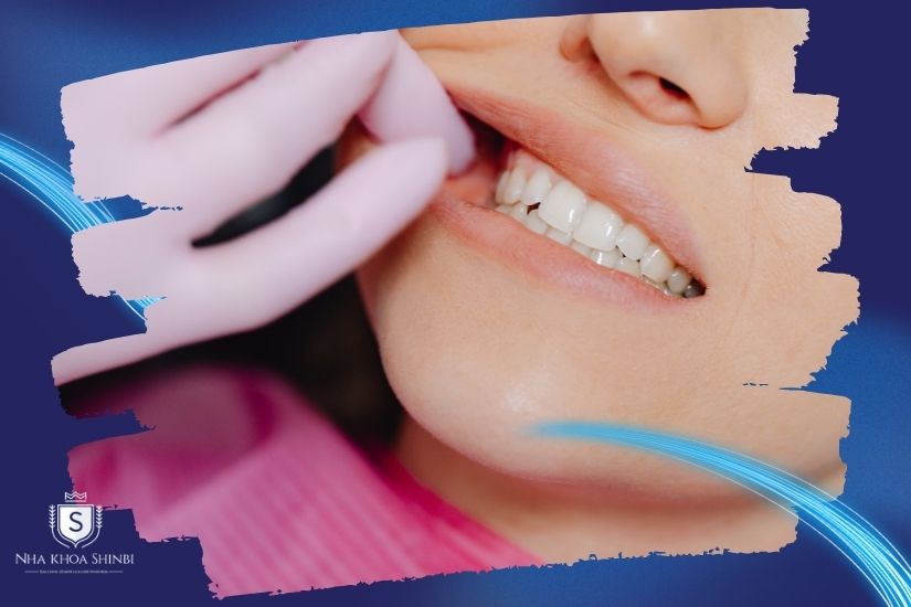 Ưu điểm nổi bật làm răng sứ nhanh