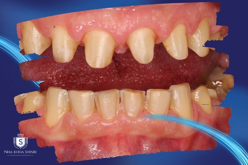 Mài răng và gắn răng tạm