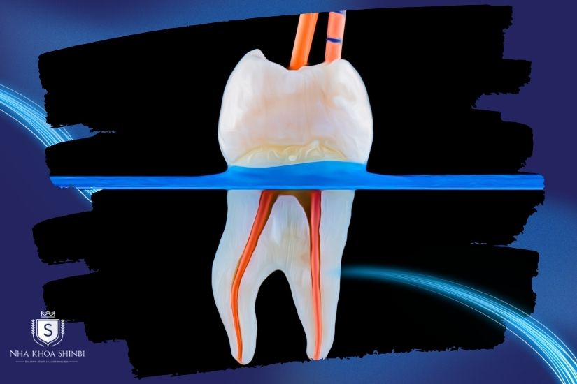 Lấy tủy bọc răng sứ Lấy tủy bọc răng sứ