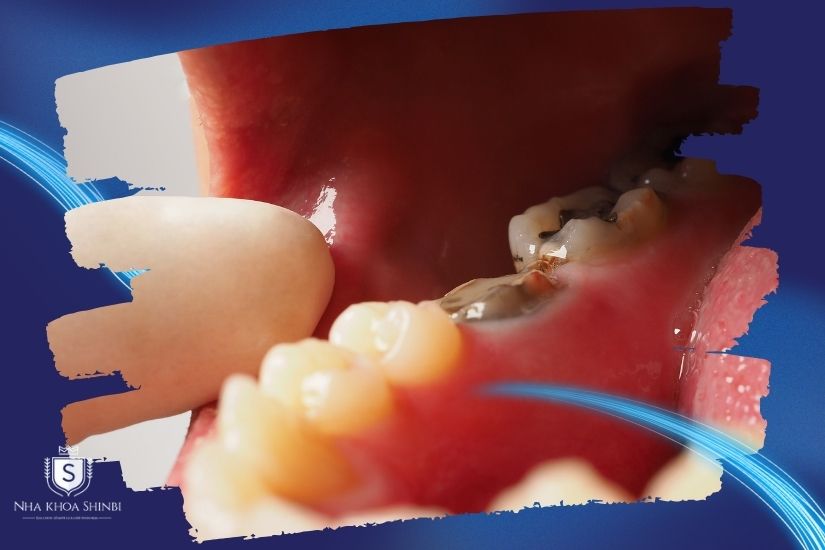 Quy trình lấy tủy bọc răng sứ Quy trình lấy tủy bọc răng sứ