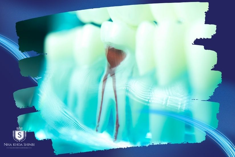 Giải mã lấy tủy bọc răng sứ bao nhiêu tiền và có nên hay không Giải mã lấy tủy bọc răng sứ bao nhiêu tiền và có nên hay không