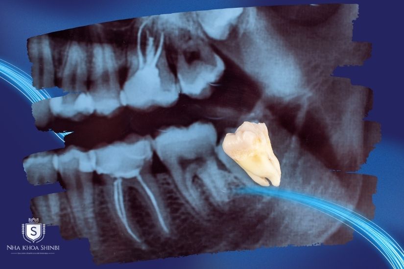 Vệ sinh răng khó khăn 