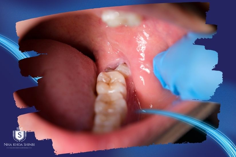 Răng khôn bị sâu