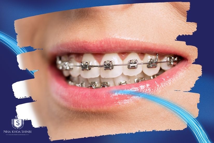 Niềng răng mắc cài kim loại Niềng răng mắc cài kim loại