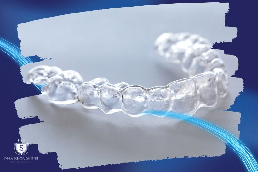 Niềng răng trong suốt Niềng răng trong suốt