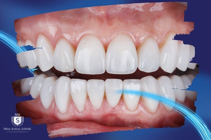 Niềng răng sứ thẩm mỹ Niềng răng sứ thẩm mỹ