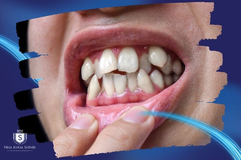 Giải mã răng khểnh có nên bọc sứ hay không Giải mã răng khểnh có nên bọc sứ hay không