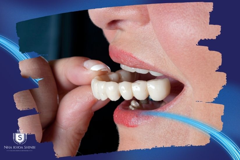 Gắn răng tạm Gắn răng tạm