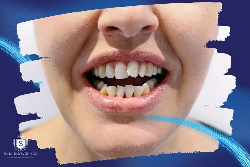 Răng khểnh mọc lệch Răng khểnh mọc lệch