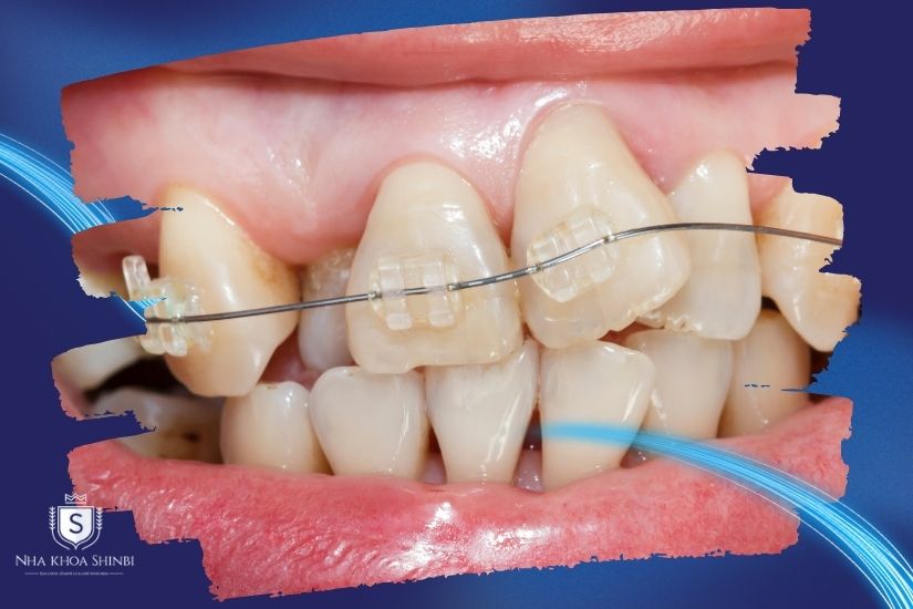 Phương pháp niền răng cho răng khểnh Phương pháp niền răng cho răng khểnh