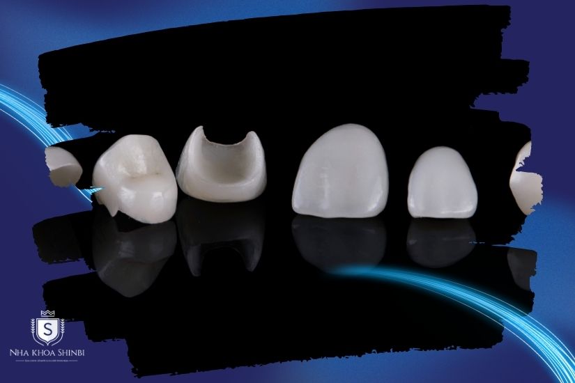 Phương pháp dán sứ Veneer Phương pháp dán sứ Veneer