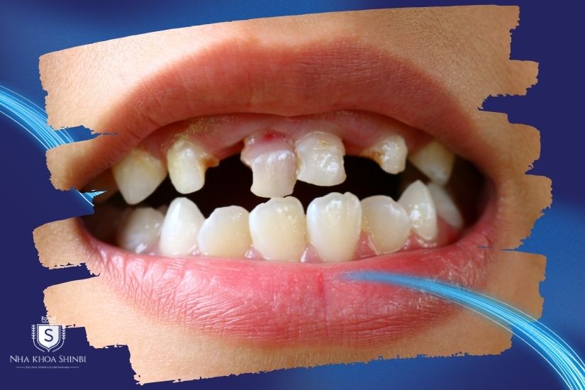 Giải mã răng lung lay có niềng được không Giải mã răng lung lay có niềng được không