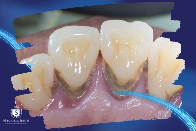 Viêm nha chu mạn tính không nên niềng răng Viêm nha chu mạn tính không nên niềng răng