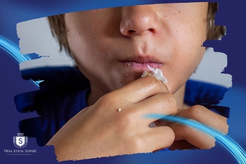 Lực nhai sai lệch Lực nhai sai lệch