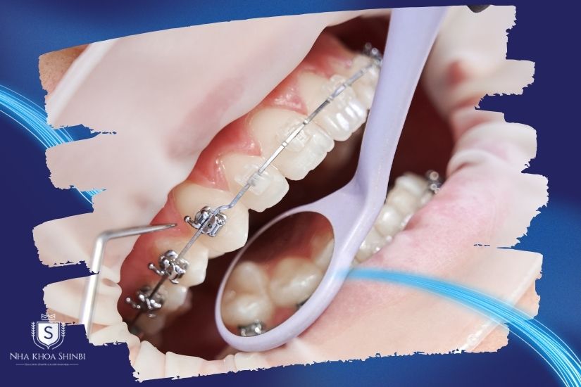 Răng lung lay có niềng được không phụ thuộc vào nhiều yếu tố Răng lung lay có niềng được không phụ thuộc vào nhiều yếu tố