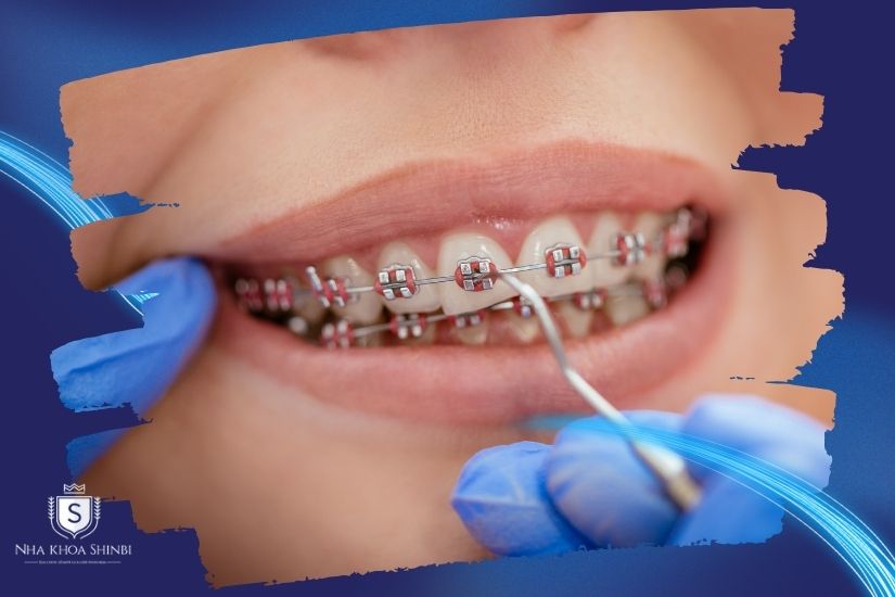 Ảnh hưởng đến hiệu quả niềng Ảnh hưởng đến hiệu quả niềng