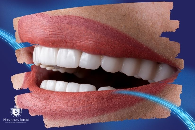 Thay răng sứ thẩm mỹ