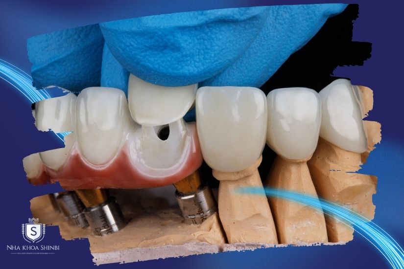 Gắn răng sứ cố định