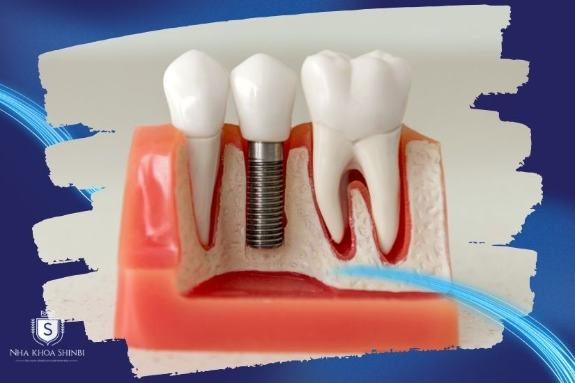 Trồng răng sứ thẩm mỹ Trồng răng sứ thẩm mỹ