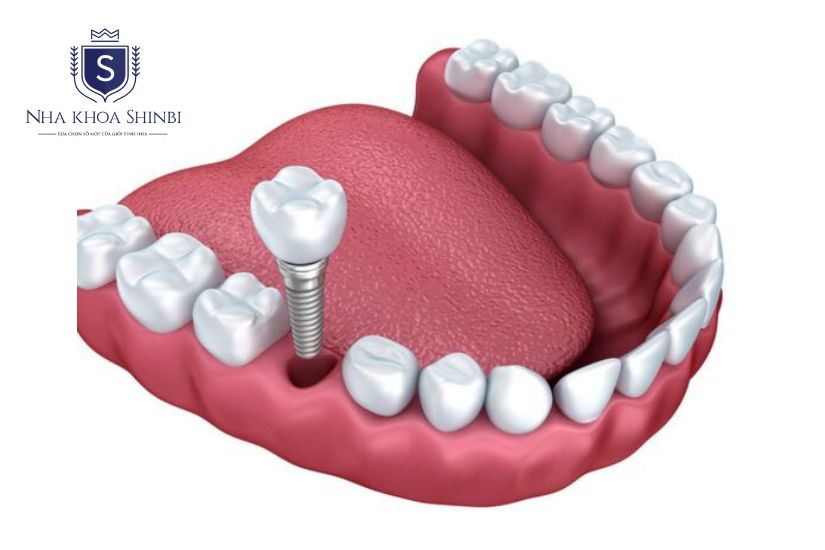 Shinbi sử dụng trụ implant và răng sứ chất lượng cao Shinbi sử dụng trụ implant và răng sứ chất lượng cao
