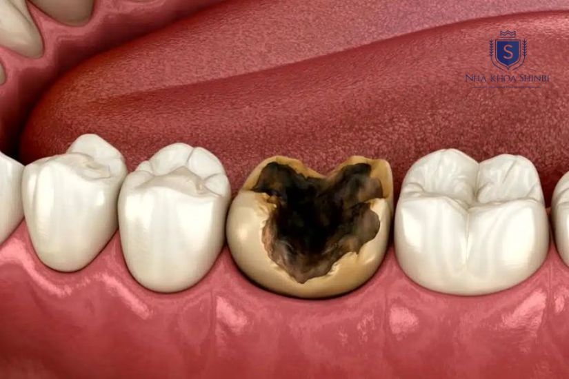 Cần điều trị sâu răng kịp thời