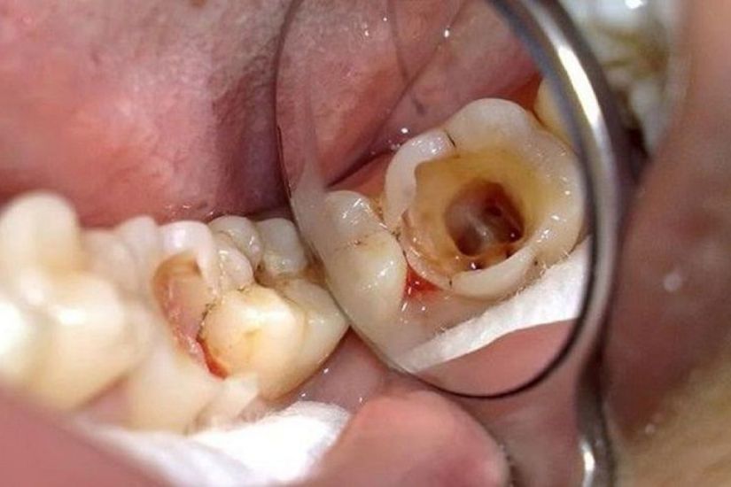 Tình trạng sức khỏe răng miệng ảnh hưởng đến chi phí trồng lại răng do sâu răng