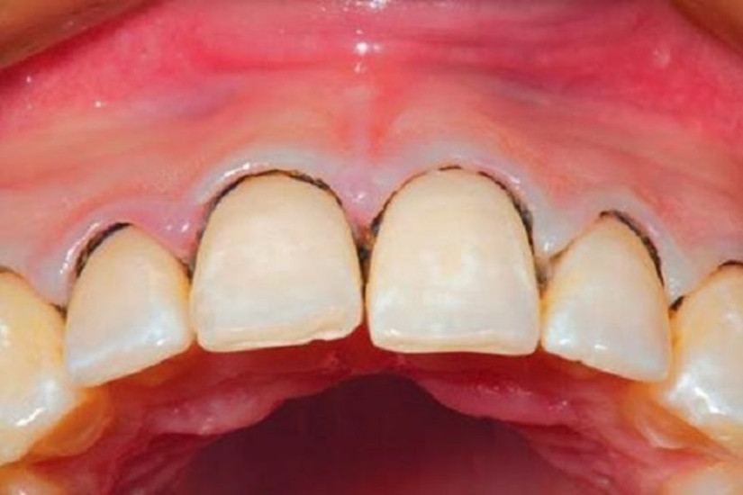 Địa chỉ chữa viêm nha chu cho người lớn tuổi tại Hà Nội