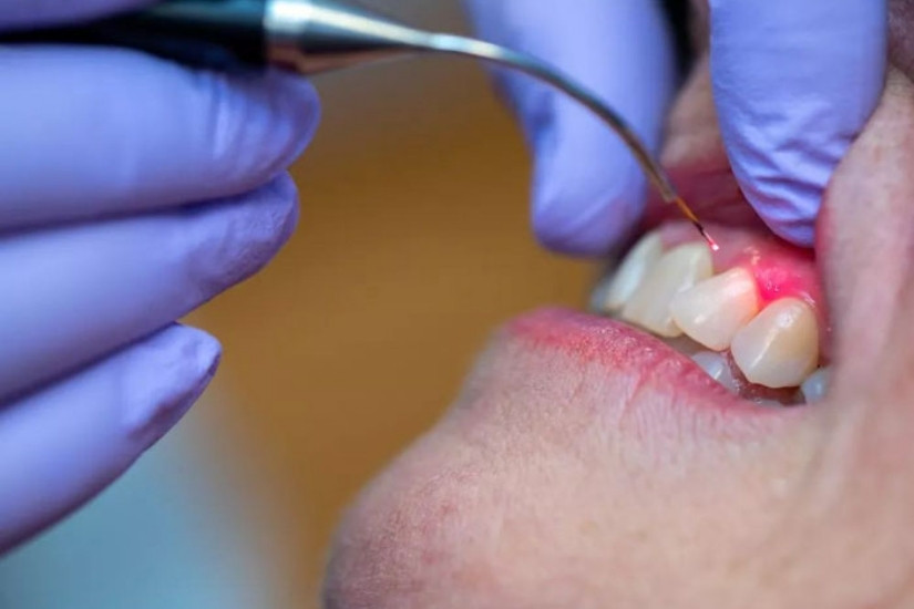 Địa chỉ chữa viêm nha chu cho người lớn tuổi tại Hà Nội