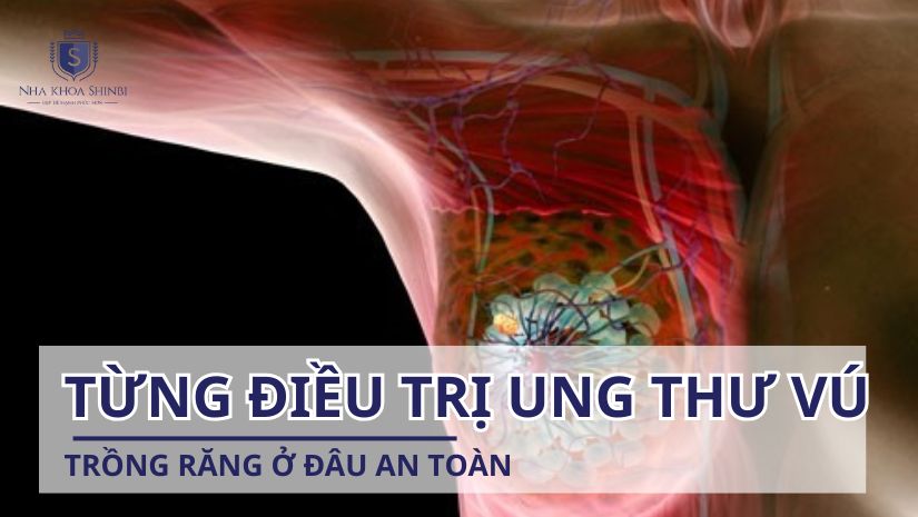 Đã từng điều trị ung thư vú trồng răng ở đâu an toàn?