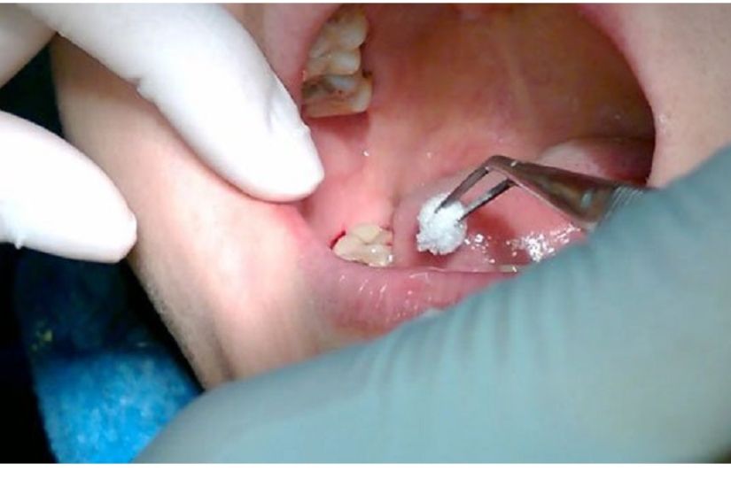 Ảnh hưởng đến khả năng lành thương sau điều trị nha khoa