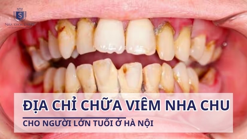 Địa chỉ chữa viêm nha chu cho người lớn tuổi tại Hà Nội