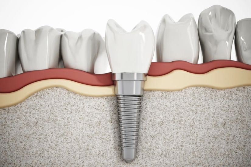 Dành cho khách hàng mất răng – bao gồm cả người hút thuốc – dịch vụ trồng răng Implant tại Shinbi giúp phục hồi khả năng ăn nhai và thẩm mỹ