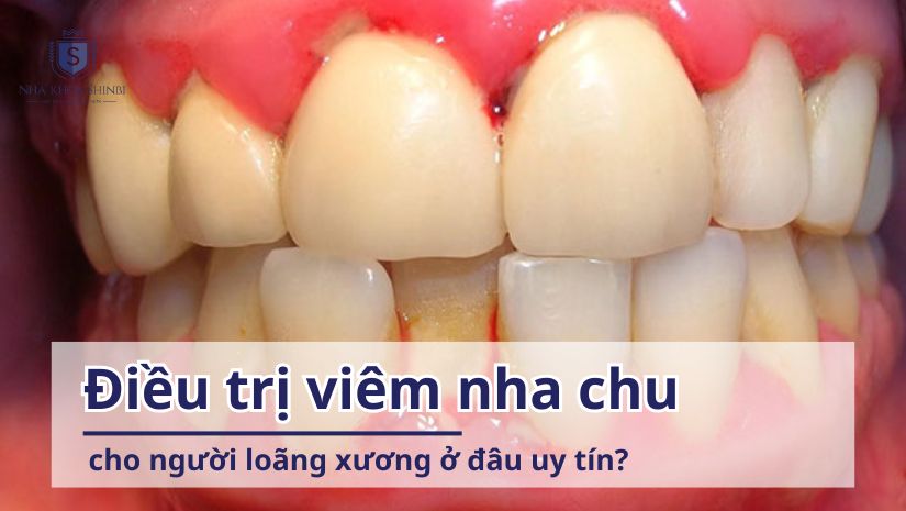 Điều trị viêm nha chu cho người loãng xương ở đâu uy tín?