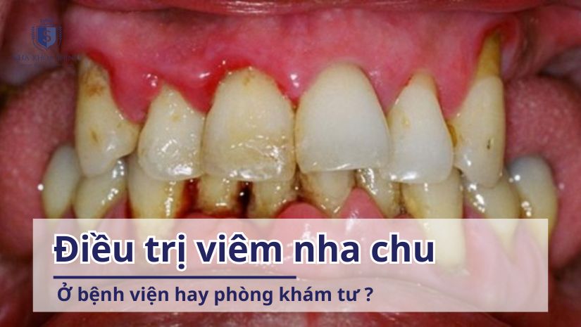 Điều trị viêm nha chu ở bệnh viện hay phòng khám tư?