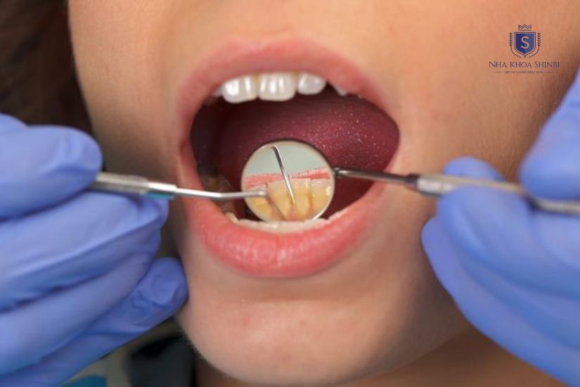 Làm sạch mảng bám và vôi răng Làm sạch mảng bám và vôi răng