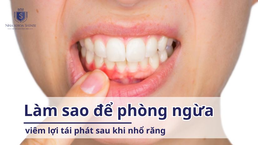 Làm sao để phòng ngừa viêm lợi tái phát sau khi nhổ răng?