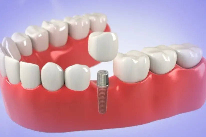 Phòng khám trồng răng cho người loãng xương