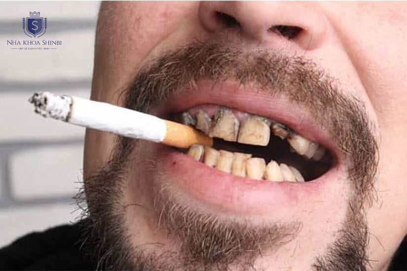 Người hút thuốc có thể trồng lại răng implant tuỳ tình trạng Người hút thuốc có thể trồng lại răng implant tuỳ tình trạng