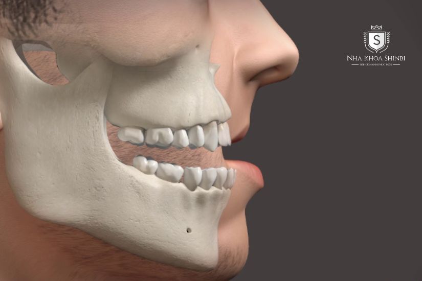 Người hút thuốc muốn trồng lại Implant phải có xương hàm đủ tốt Người hút thuốc muốn trồng lại Implant phải có xương hàm đủ tốt