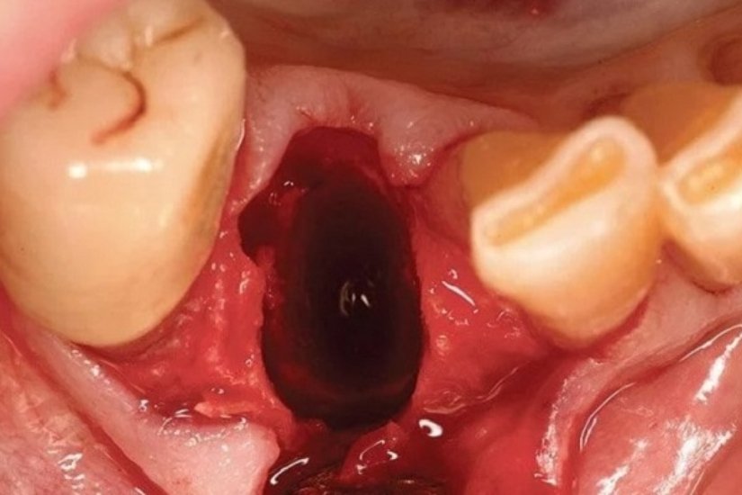 Nhổ răng ở người viêm lợi có cần làm sạch vùng viêm kỹ không?